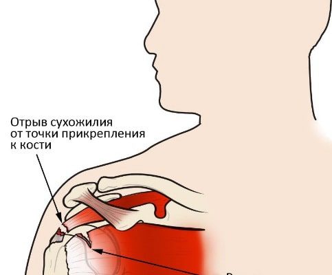 Особенности реабилитации после травм плечевого пояса у спортсменов