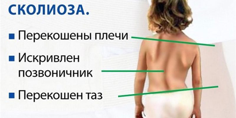 Профилактика сколиоза у детей⁚ упражнения и рекомендации 8 Профилактика сколиоза у детей⁚ упражнения и рекомендации